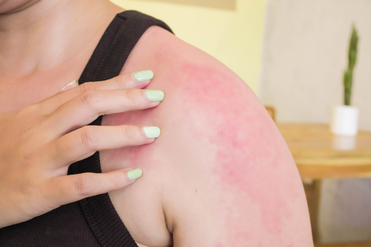 Hands holding sunburn on shoulders.