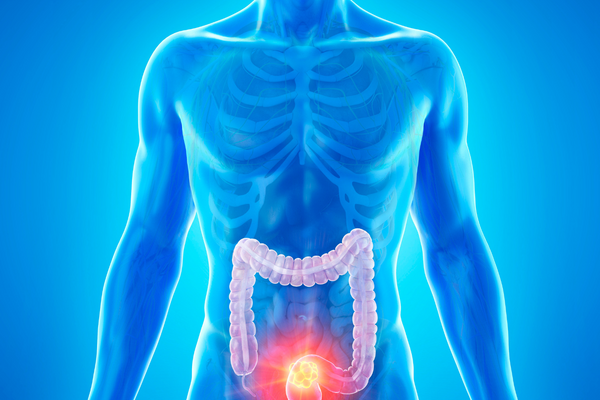 Illustration of colon with cancer tumor.